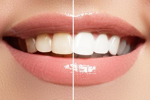 How To Get Shiny Teeth? Top Tips for a Radiant Smile