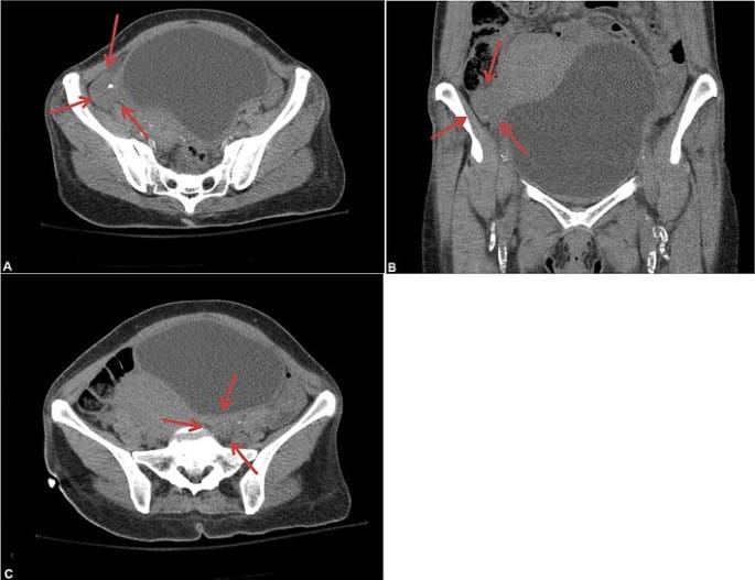 Understanding Non-Visualization of Ovaries: Causes & Implications